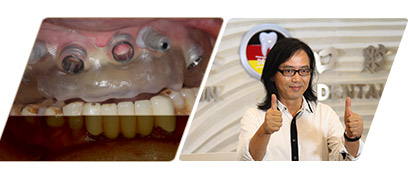 數(shù)字化種植牙介紹