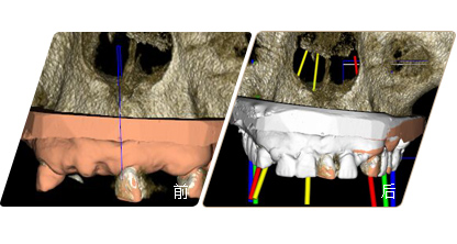 數(shù)字化種植牙設(shè)計軟件前后對比